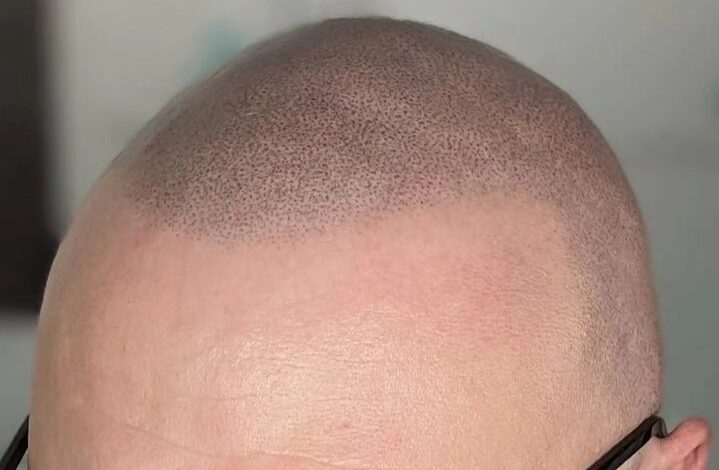 Hair loss, balding, scarring, or hair restoration?