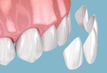 dental implants in Melbourne