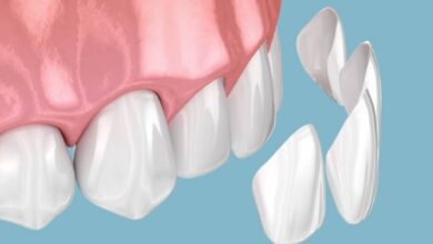 dental implants in Melbourne