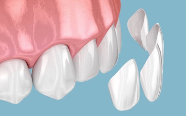 dental implants in Melbourne
